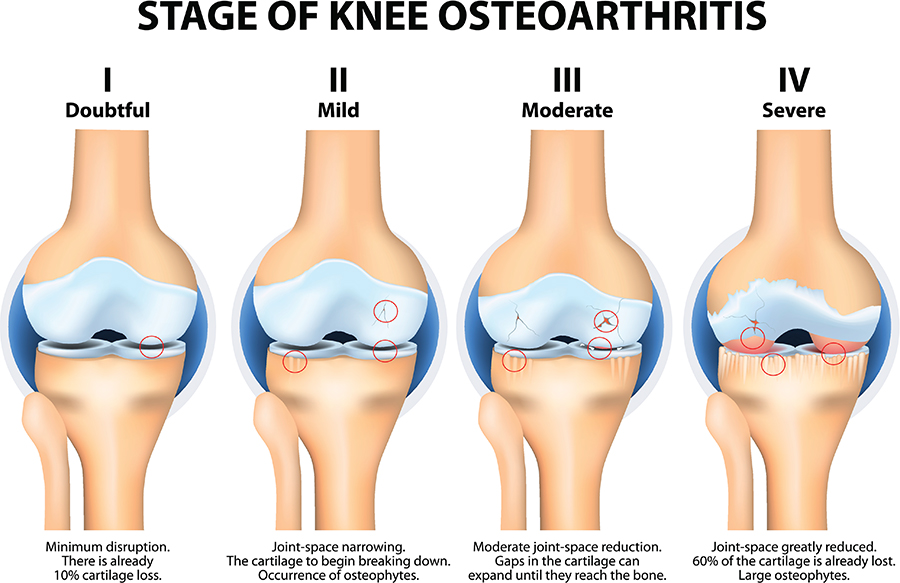Arthritis Pain Stages of Knee Osteoarthritis